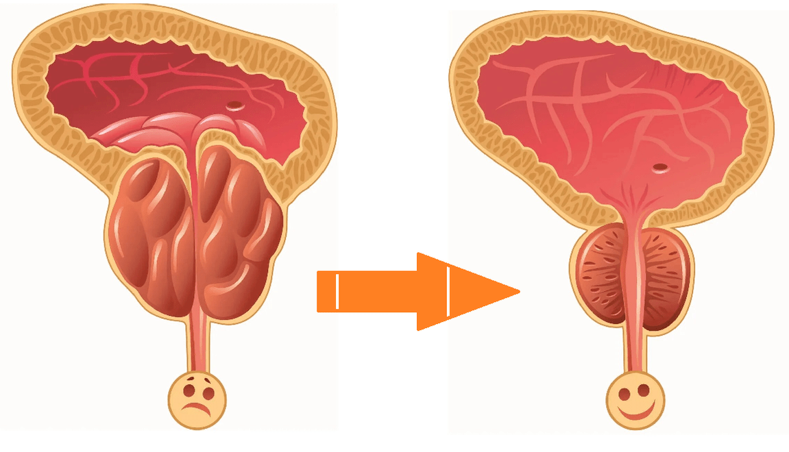 Uromexil Forte Azione sulla prostata con prostatite e adenoma