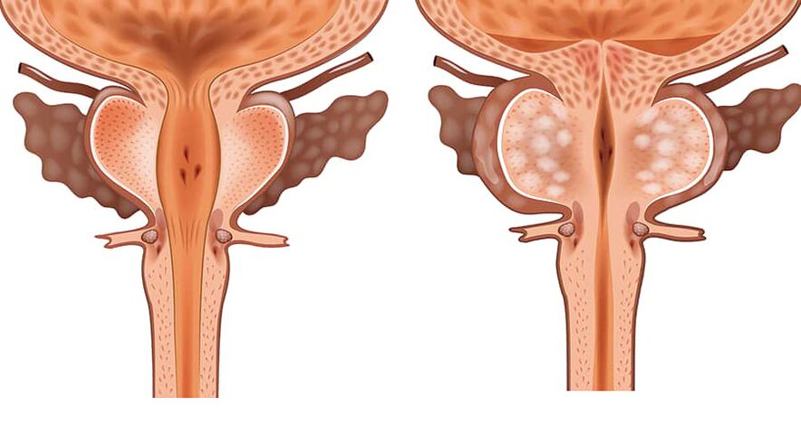 confronto tra adenoma sano e infiammato