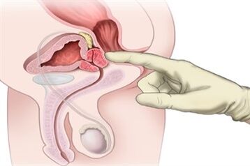 Massaggio prostatico per il trattamento della prostatite cronica