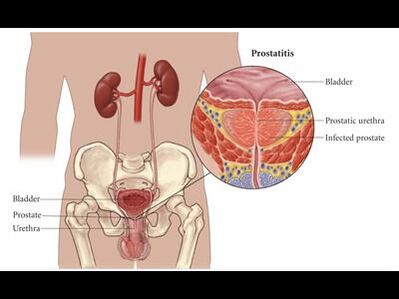 Prostatite – infiammazione della ghiandola prostatica
