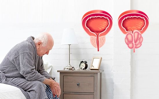 prostatite in un uomo